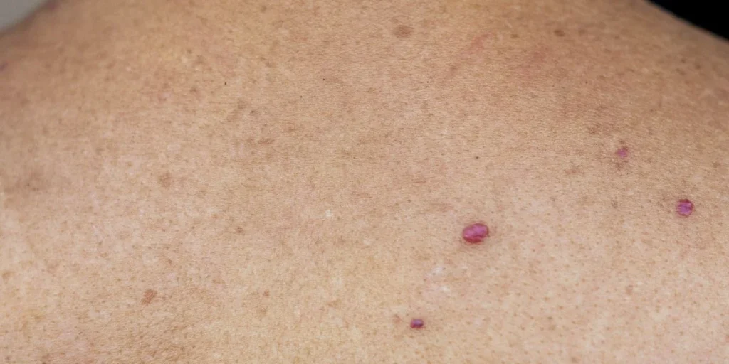 cherry angiomas, røde prikker