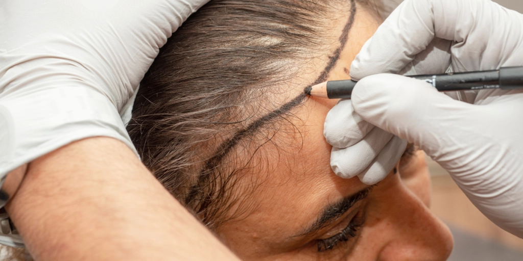 Kvinna hårtransplantation