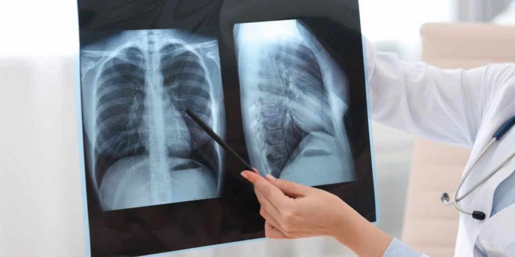 lung cancer Lung disease. Doctor examining chest x-ray in clinic, closeup