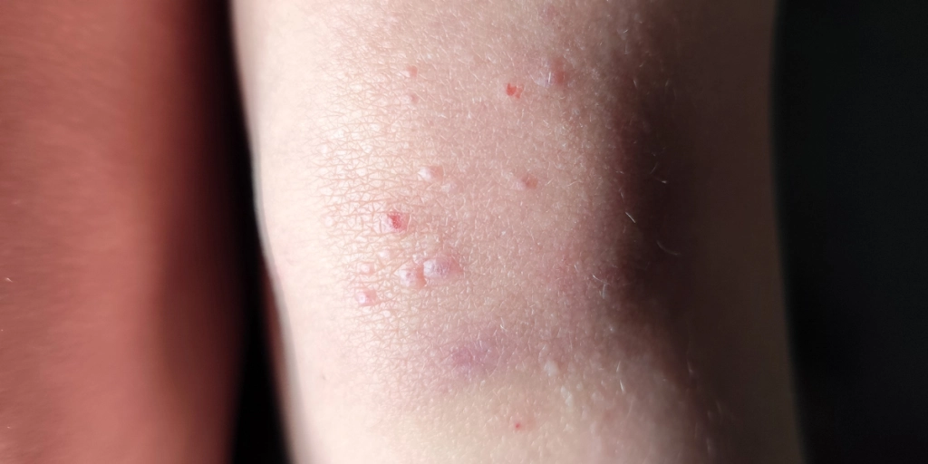 Molluscum contagiosum, water warts