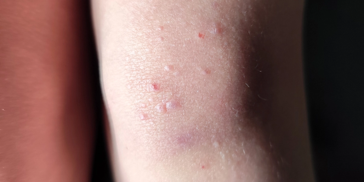 Computer Virus Skin Study: Human brain gene has jumped and settled in a common skin virus ...